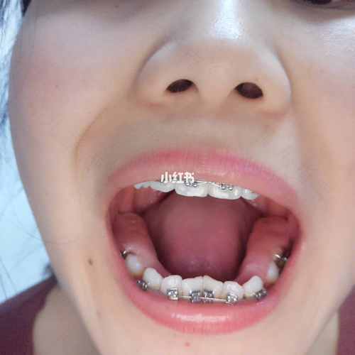 大舌头如何纠正发音 大舌头如何纠正发音