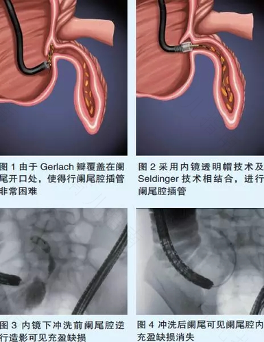 女性阑尾炎手术后多久可以同房 女性阑尾炎手术后多久可以同房