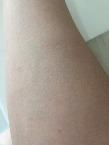 宝宝皮下出血点 原因 宝宝皮下出血点 原因