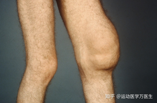 膝盖有积液怎么办怎么治疗 膝盖有积液怎么办怎么治疗