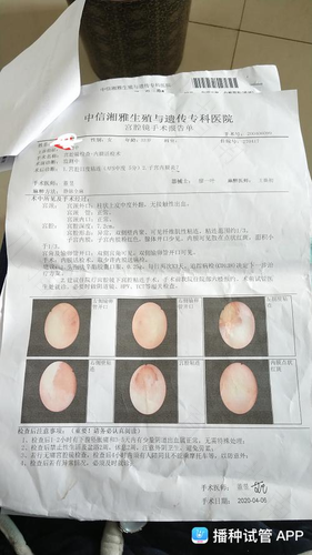 宫腔镜检查能看到什么内容