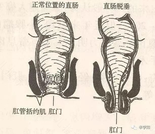 生孩子有肛脱怎么办 生孩子有肛脱怎么办