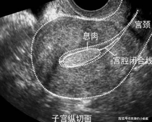 子宫息肉老是复发怎么根治 子宫息肉老是复发怎么根治