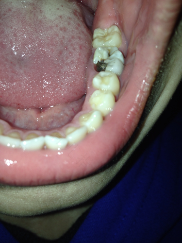 儿童后槽牙掉了一半怎么办 儿童后槽牙掉了一半怎么办