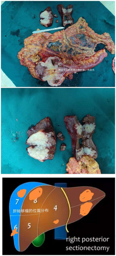 肠癌肝转移可以治疗吗 肠癌肝转移可以治疗吗