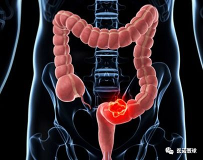 肠炎有哪些症状表现 肠炎有哪些症状表现