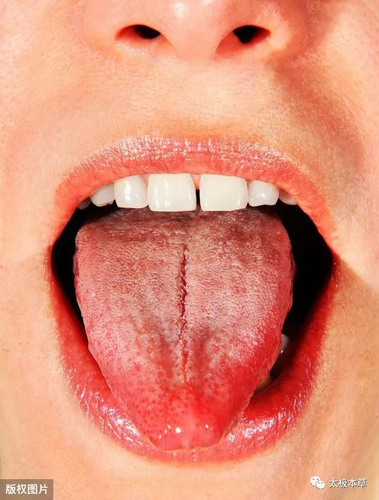 舌头上有齿痕是怎么回事怎么治 舌头上有齿痕是怎么回事怎么治