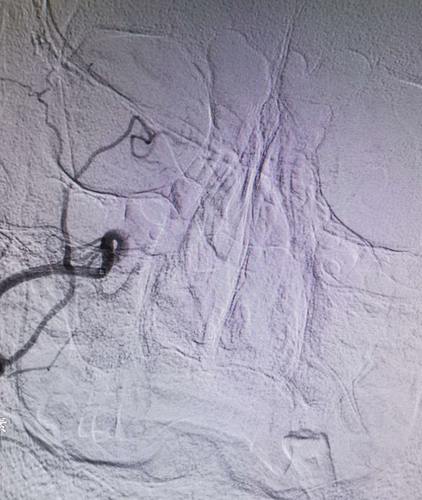 鼻子做手术后出血怎么办