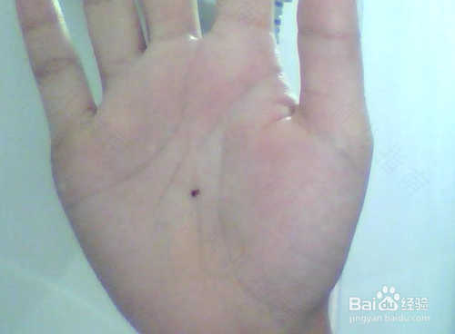 发烧手心发热是怎么回事 发烧手心发热是怎么回事