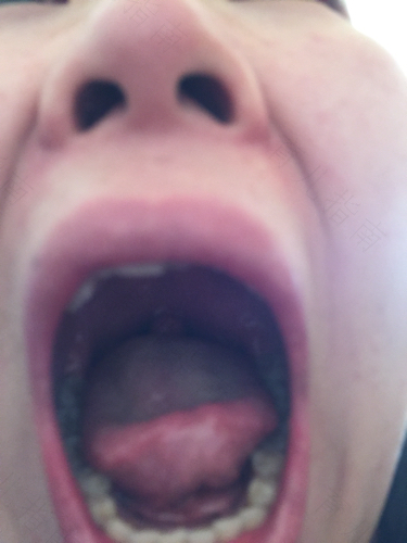 喉咙痛咳出血痰是什么原因