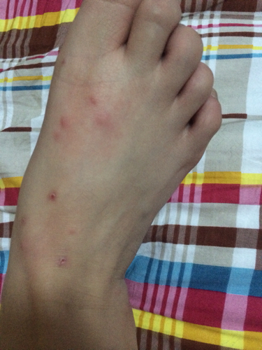 婴儿湿疹会不会痒