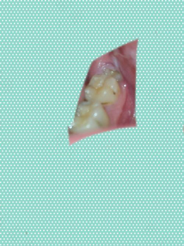 上牙后牙龈肿痛怎么办 上牙后牙龈肿痛怎么办