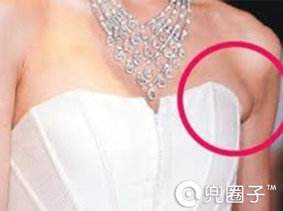 副乳腺怎么治疗