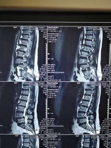 腰脱怎么治疗效果好 腰脱怎么治疗效果好