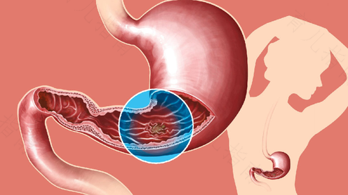 常年胃酸怎么治疗方法