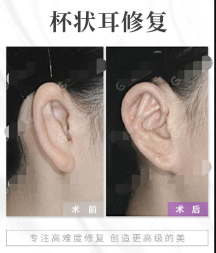 杯状耳手术费大概多少