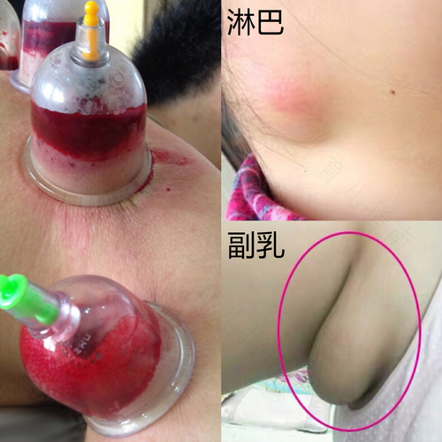 副乳下面疼是怎么回事 副乳下面疼是怎么回事