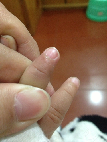 手指上有倒刺怎么办 手指上有倒刺怎么办