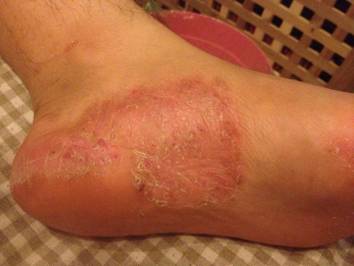 湿疹会长在脚上吗 湿疹会长在脚上吗