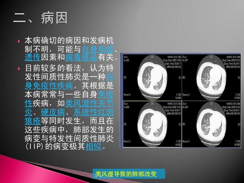 间质性肺炎什么原因引起的