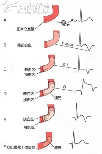 心梗前兆会有腹泻症状吗 心梗前兆会有腹泻症状吗