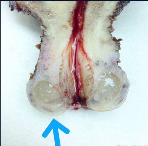 宫颈纳氏腺囊肿如何治疗
