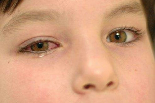 咳嗽有眼屎是怎么回事 咳嗽有眼屎是怎么回事