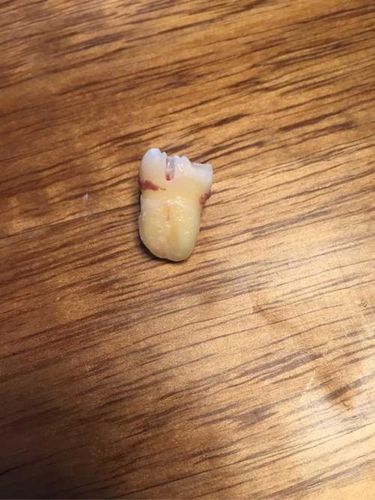 在家怎么拔牙最快而且不疼 在家怎么拔牙最快而且不疼