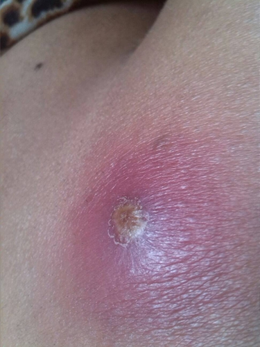 臀部都是疙瘩怎么回事 臀部都是疙瘩怎么回事