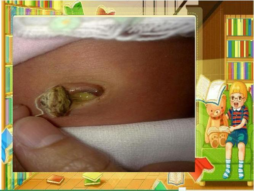 脐炎和脐疝的区别