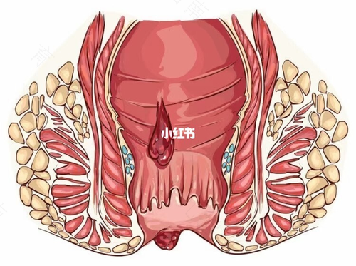 痔疮手术四个月了还不好怎么办 痔疮手术四个月了还不好怎么办