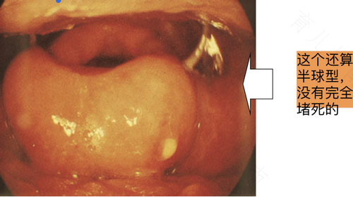 喉咙发炎怎么好得快 喉咙发炎怎么好得快