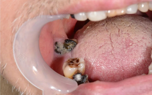 宝宝嘴巴里长溃疡怎么办 宝宝嘴巴里长溃疡怎么办