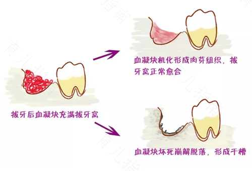 怎么判断有没有干槽症如何避免