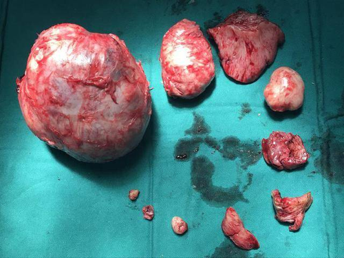 子宫切除会影响什么 子宫切除会影响什么