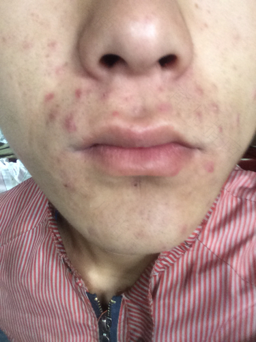 嘴角周围一直长痘怎么办 嘴角周围一直长痘怎么办