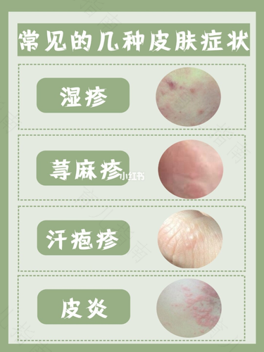 儿童阴囊湿疹反反复复怎么办 儿童阴囊湿疹反反复复怎么办