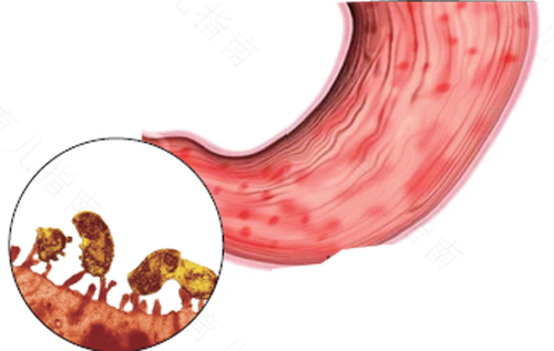 慢性胃炎导致贫血的主要原因是 慢性胃炎导致贫血的主要原因是