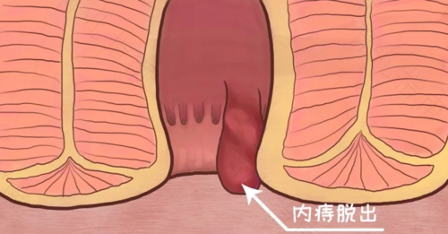 痔疮可以自愈吗 女性 痔疮可以自愈吗 女性