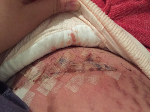 剖腹产后尿路感染怎么办 剖腹产后尿路感染怎么办