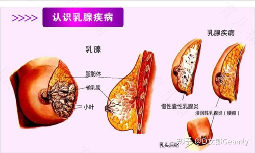 乳腺增生会很疼吗 乳腺增生会很疼吗