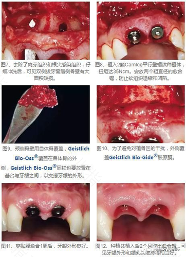 拔牙后的牙洞怎么清理食物