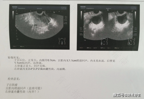 子宫内膜异位症可以治愈吗 子宫内膜异位症可以治愈吗