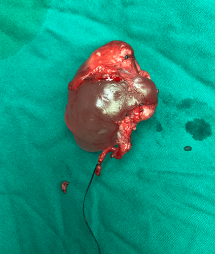 阴囊鞘膜积液怎么回事图片 阴囊鞘膜积液怎么回事图片