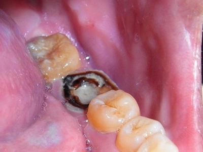 7岁蛀牙烂到牙根 7岁蛀牙烂到牙根