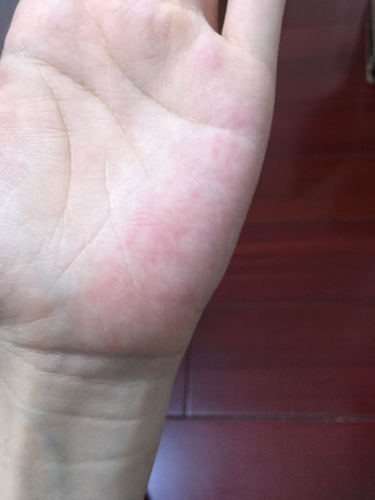 手心发热发痒是怎么回事?