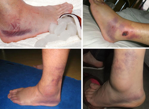 脚扭伤发青发紫是怎么回事 脚扭伤发青发紫是怎么回事