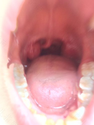 喉咙上火发炎怎么办最有效 喉咙上火发炎怎么办最有效