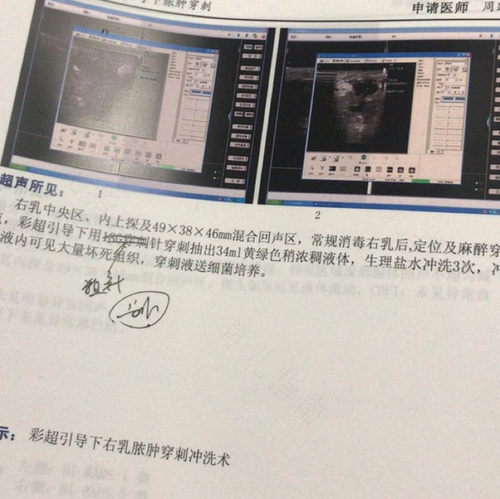 乳腺囊肿做穿刺好不好