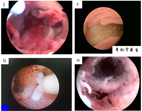子宫腔镜息肉手术后要休息几天 子宫腔镜息肉手术后要休息几天